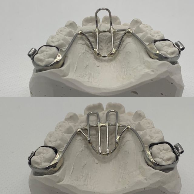 Different flavors of a tongue/thumb habit appliance. Top one is a #curl, bottom is a #crib. 
#thumbsucking #thumbcrib #tonguehabit #fixed #appliance #habit #breaker #stainlesssteel #wire #silver #solder #orthodontics #ortho #orthodontist #dentistry #dental #dentist #dentalart #ortodoncie #ortodoncia #ortodonzia #ortodontia